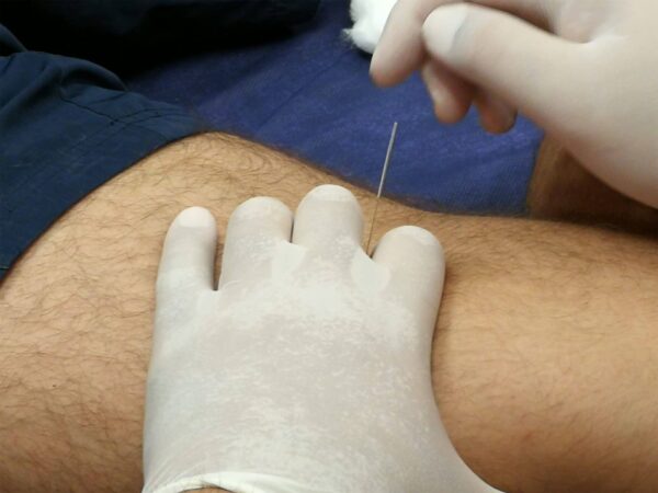 Punción Seca y Electropunción – Aplicada a Patología Clínica - Madrid